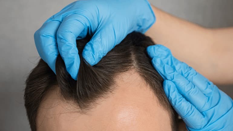 Hair Transplant Istanbul – Enhance Your Hair, Enhance Your Confidence